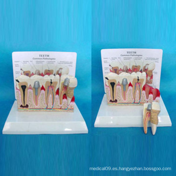 Anatomía de los dientes patológicos Modelo de cuidado dental para la enseñanza (R080119)